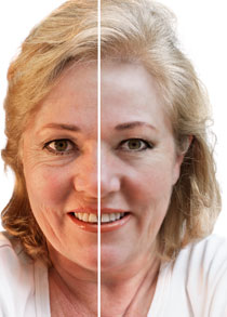 Before and after from the botox website. Looks pretty good right?